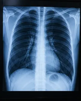 X-Ray